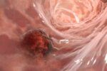 tumor usus adalah