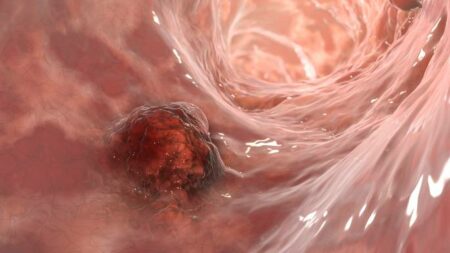 tumor usus adalah