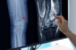 tumor tulang