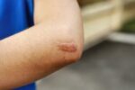 keloid