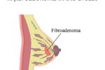 fibroadenoma adalah