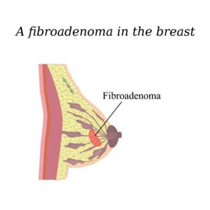 fibroadenoma adalah